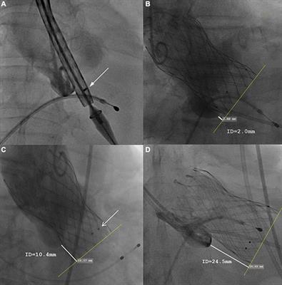 Anatomic predictor of severe prosthesis malposition following transcatheter aortic valve replacement with self- expandable Venus-A Valve among pure aortic regurgitation: A multicenter retrospective study